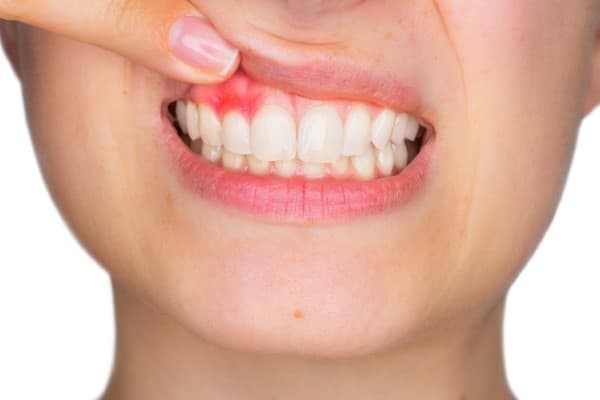 Mouth problems
